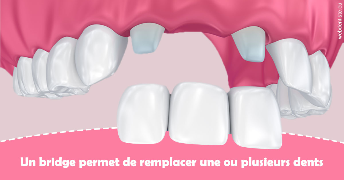 https://selarl-dr-rapoport.chirurgiens-dentistes.fr/Bridge remplacer dents 2