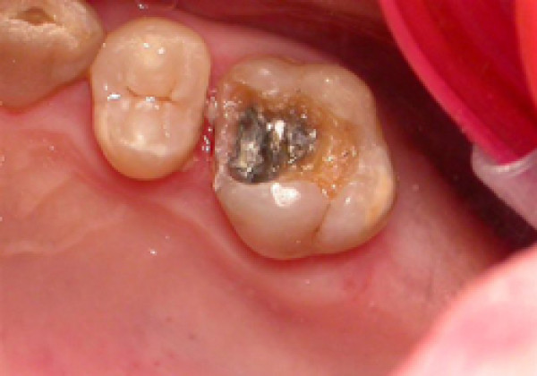 Remplacement d'une molaire du haut par un implant et pose d'un onlay sur la dent voisine.