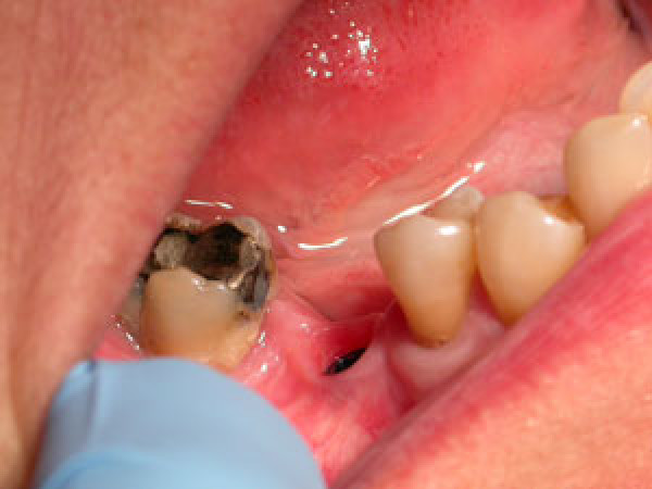 Remplacement d'une molaire inférieure par un implant